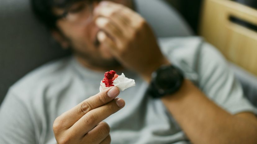 A man holding up a bloody tissue with one hand while trying to stop his nosebleed with his other hand. 