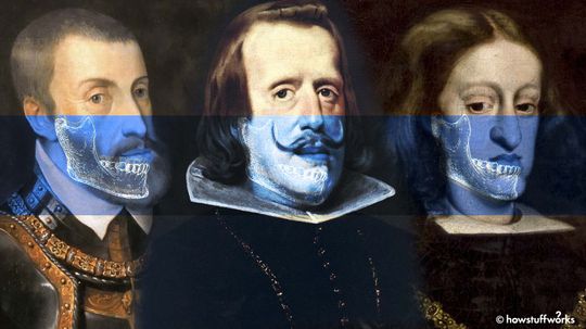 How Centuries of Inbreeding Led to the Distinctive 'Habsburg Jaw'