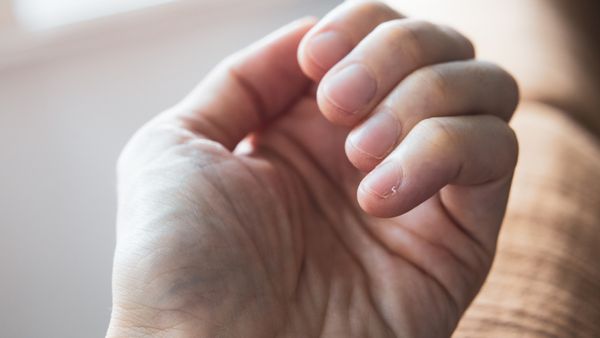 A hand with a hangnail on the pinky finger. 