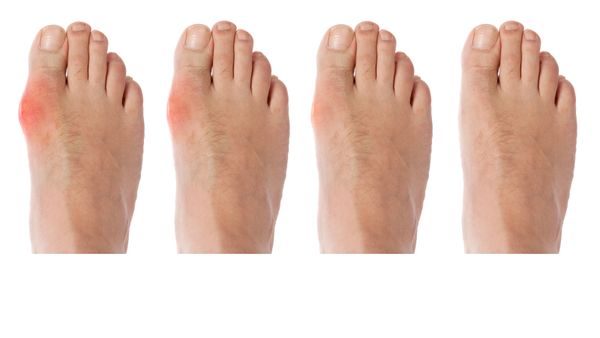 The healing process of gout arthritis on a toe. 
