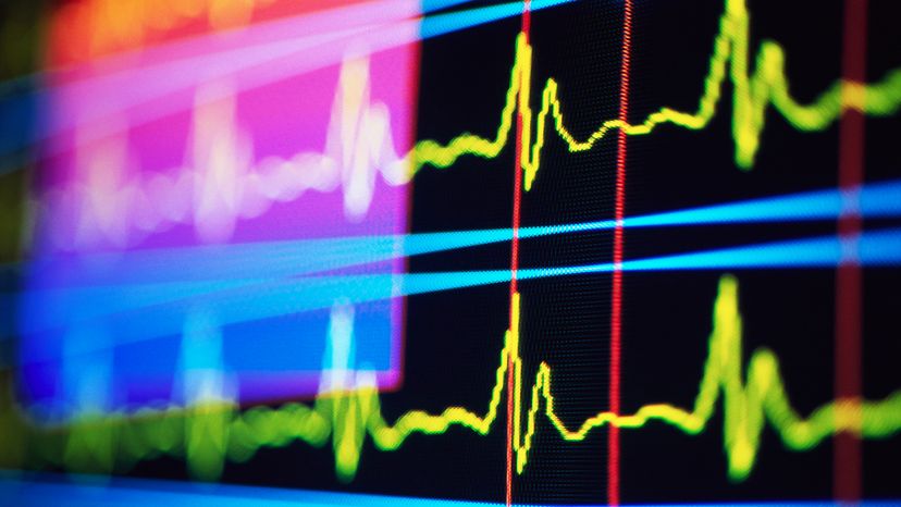 An ECG showing someone's heart beat. 