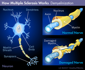 demyelinization