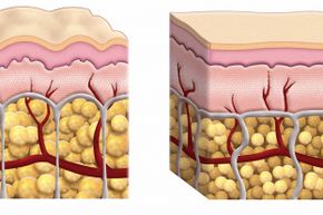 This cross-section diagram shows skin that exhibits cellulite and skin that doesn’t. Aside from the size of the fat cells, the components of each are the same.