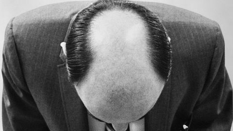 Why Aren't There More Patterns in Male Pattern Baldness? - Vimarsana News