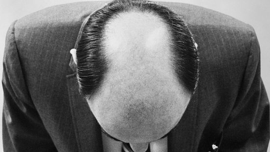 Why Aren't There More Patterns in Male Pattern Baldness?