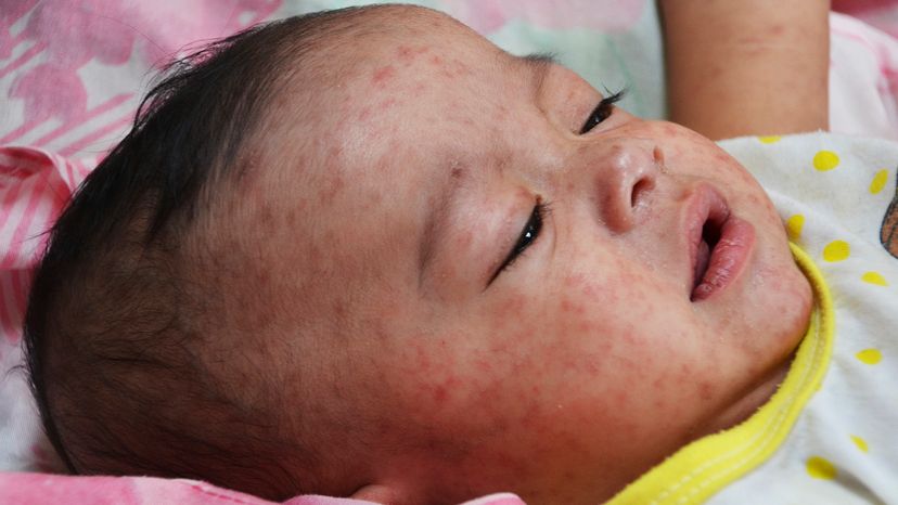 baby with measles