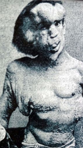 joseph merrick