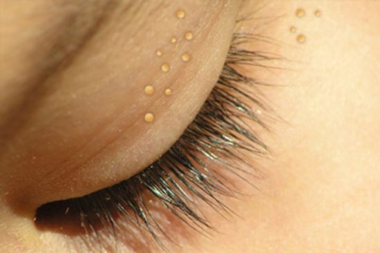 5件事你需要知道Milia”class=