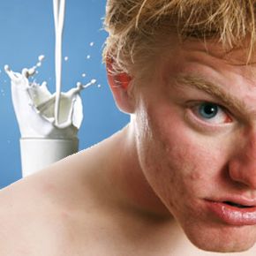 Boy with acne with glass of milk in background.