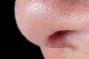 Do you have enlarged pores? See pictures of getting beautiful skin.