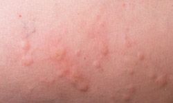 5 Skin Disorders You Might Mistake For Hives Howstuffworks