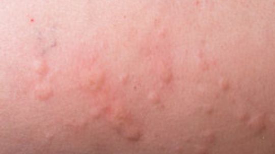 What are some common symptoms of a shellfish allergy?