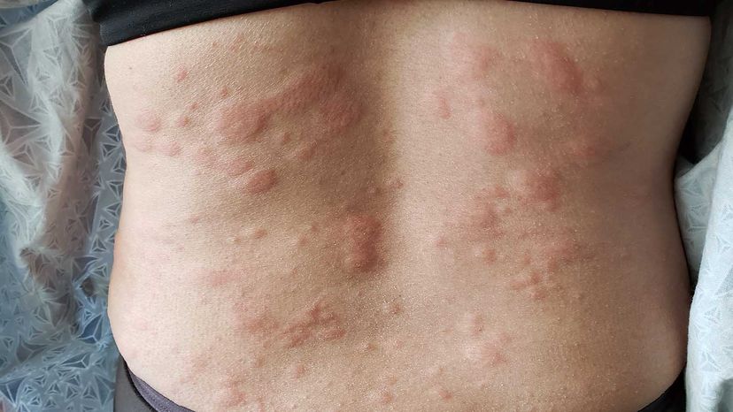 Raised Skin Bumps: Pictures, Symptoms, Causes, Treatments