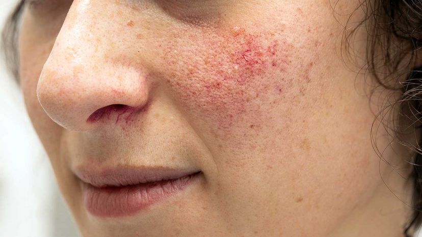 anxiety rash on face