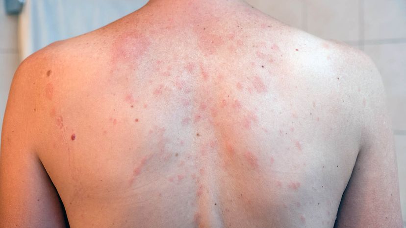 5 Skin Disorders You Might Mistake for Hives