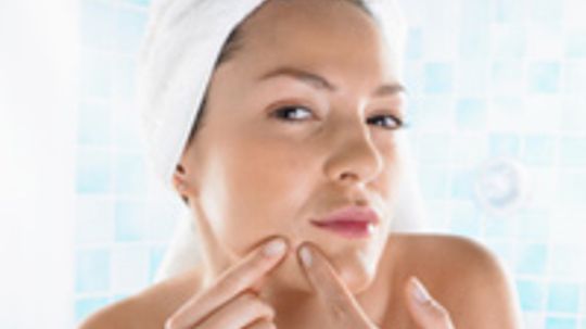 Top 10 Tips for Moisturizing Acne-prone Skin