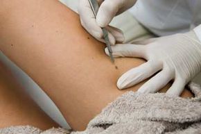 Dermatologist removing moles on a patients leg with a scalpel.