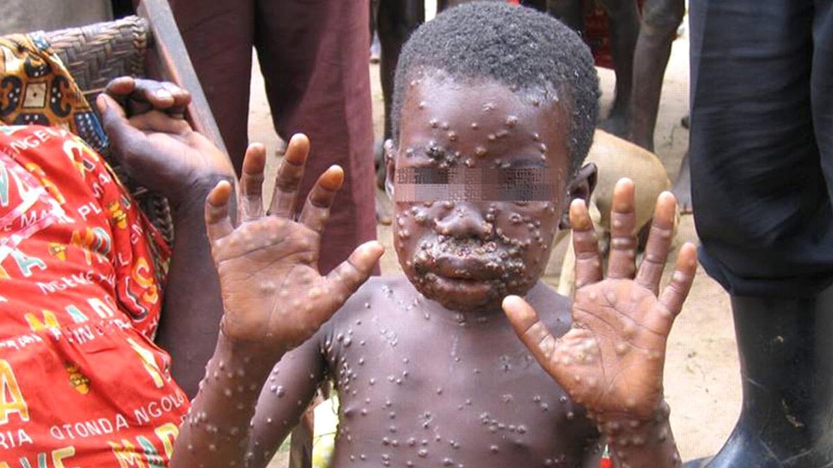 U.S. Sees First Case of Rare Monkeypox in 18 Years | HowStuffWorks