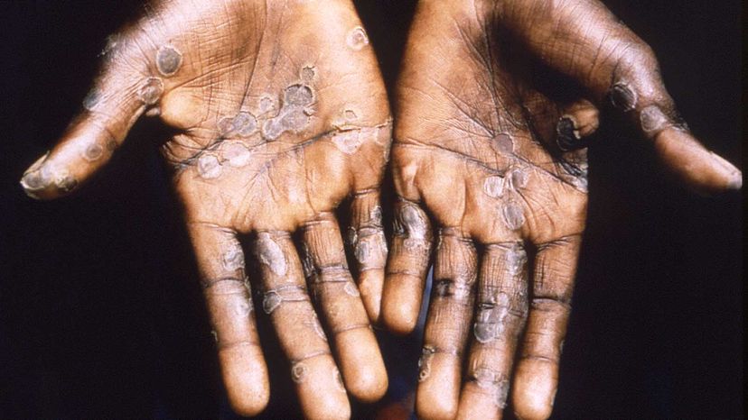 monkeypox infection