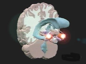 An MRI image of an overactive amygdala,