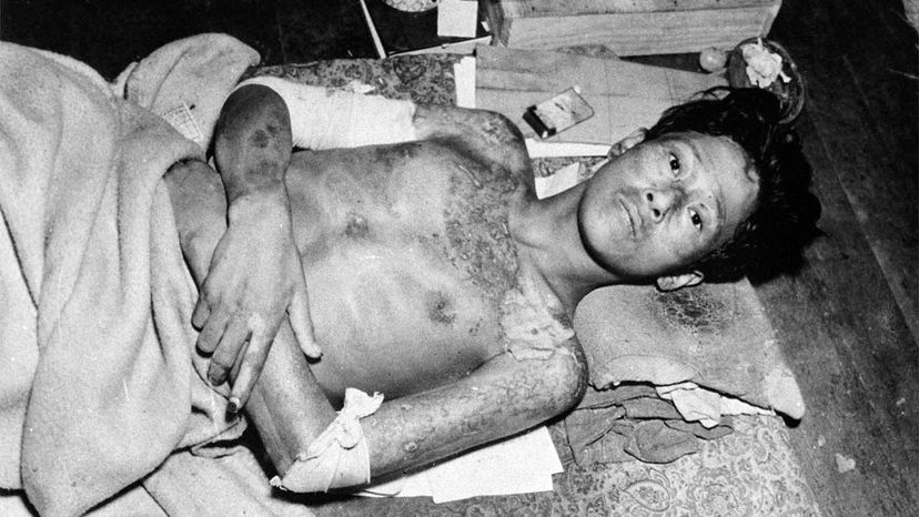 victim of Nagasaki bombing