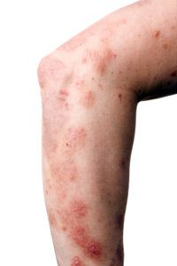 How Nummular Dermatitis Works HowStuffWorks