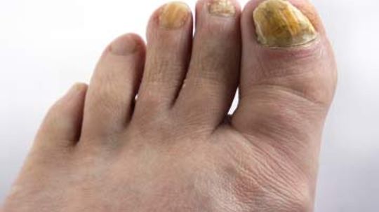 Understanding Nail Fungus