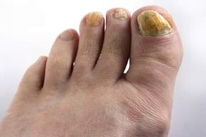 How to trim thickened toenails - Mayo Clinic