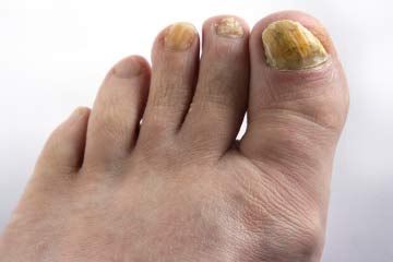 Toenail fungal infection. Yummy.