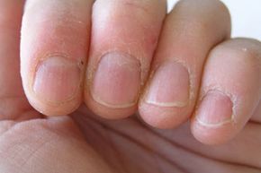 Unhealthy fingernails.