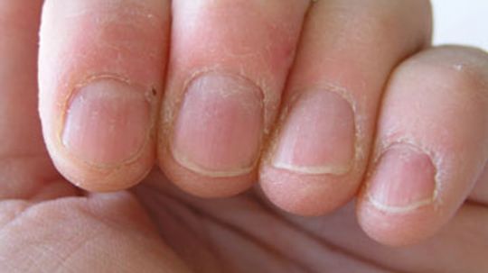 How can nails be signals of systemic disease?