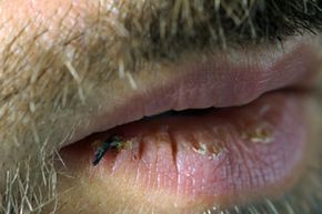 dry lips