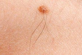 Close up of melanoma mole on woman's skin. See more pictures of skin problems.