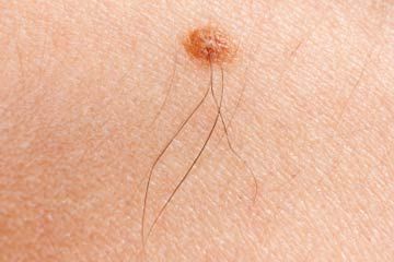 Close up of melanoma mole on woman's skin.