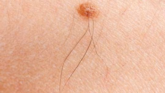 Are new moles always a sign of cancer?