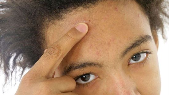 研究可能会揭示为什么今天的痤18新利最新登入疮意味着明天的皮肤更年轻＂class=