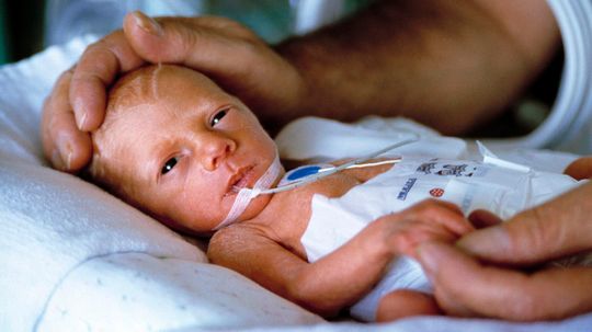Survival Rate Improving for Extremely Preterm Babies