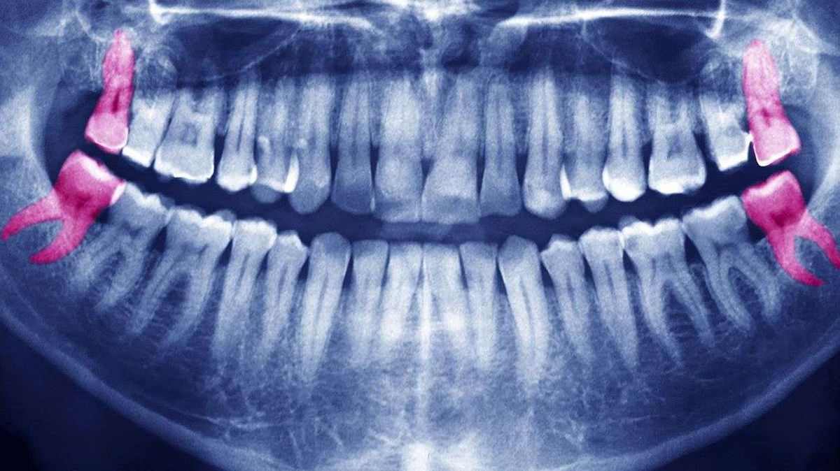 Wisdom Teeth Can Stay, Says Oral Surgery Organization