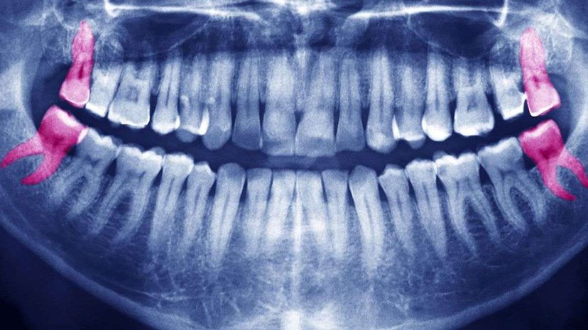 This panoramic X-ray highlights four wisdom teeth in a patient's mouth. If they're healthy, there may be no need to pull them. Instead patients and their dentists may want to consider keeping a regular eye on them. BSIP/UIG via Getty Image