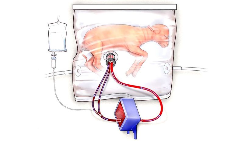 An artificial womb, recently tested with fetal lambs, could transform care for extremely preterm human babies. Children's Hospital of Philadelphia/Screenshot: HowStuffWorks