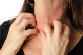 Itchy hives may respond to a tricyclic antidepressant if other treatments don't help.