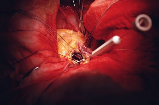 open-heart surgery