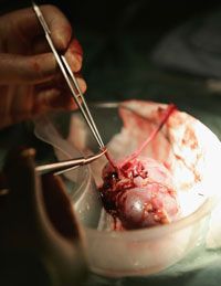 kidney transplant