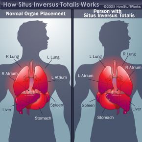 illustration of reversal of organs