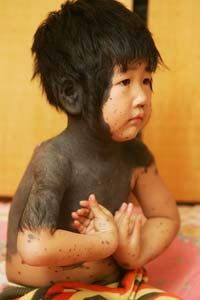 Four-year-old Jiaxue, of China, was born with hairy black moles covering parts of her back, chest, neck and face. The media reported her condition as an atavism.