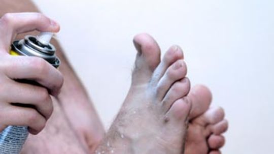 Athletes Foot Overview