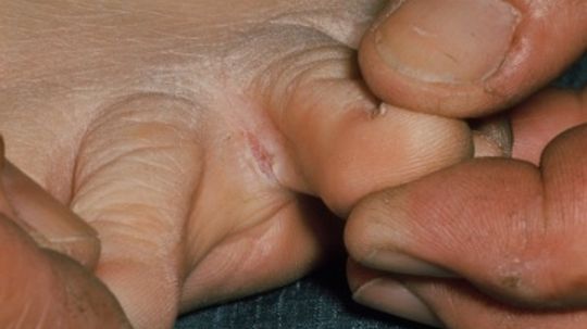 Close-up of athlete's foot Tinea pedis infection - Stock Image