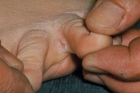 athlete's foot in between toes