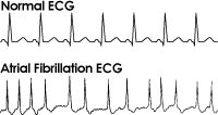 将正常心电图与心房纤颤患者的心电图进行对比＂width=