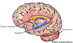 The brain of a child with autism has an abnormal corpus callosum, amygdala and cerebellum.